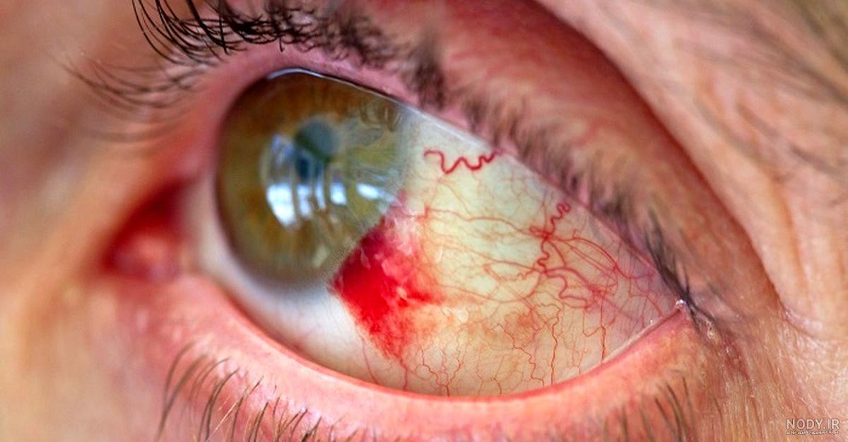 عکس چشم قرمز دخترانه عکس چشم قرمز دخترانه