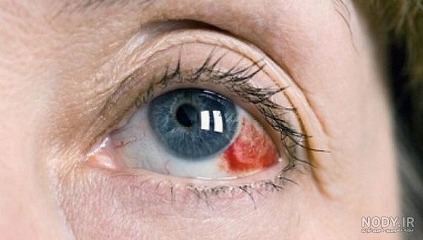 عکس چشم قرمز شده از گریه عکس چشم قرمز شده از گریه