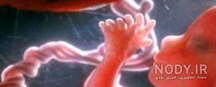 علامت اختصاری جنین پسر در سونوگرافی
