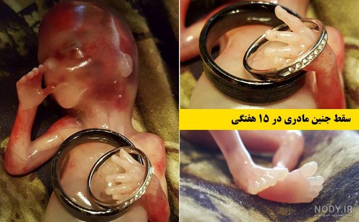 عکس از لکه بینی بارداری
