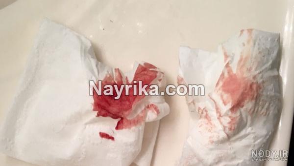 لکه بینی در بارداری تا چند روز طبیعی است