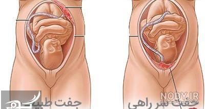 لکه بینی قرمز در بارداری نی نی سایت