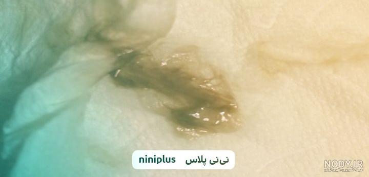عکس لکه بینی در بارداری عکس لکه بینی در بارداری