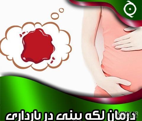 لکه بینی در بارداری نشانه پسر لکه بینی در بارداری نشانه پسر