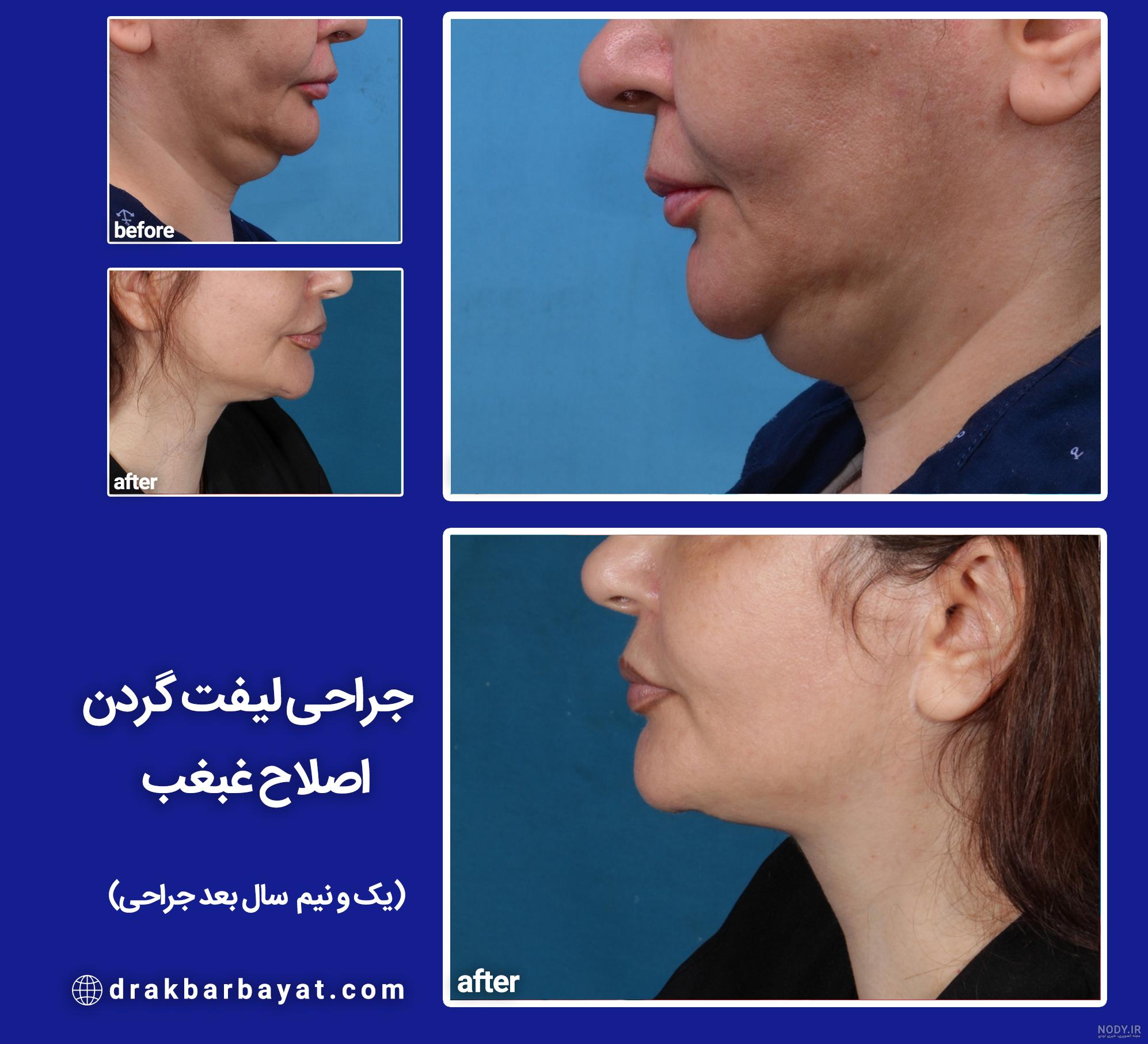 عکس غبغب قبل از عمل