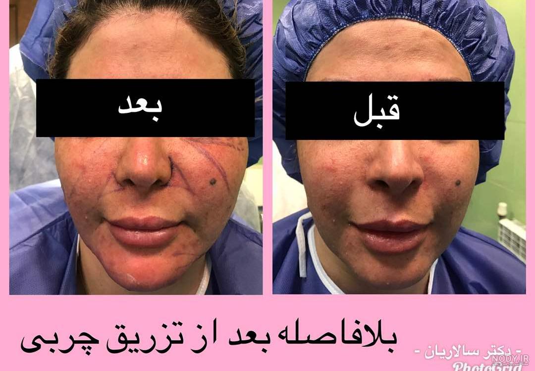آیا بعد از تزریق چربی صورت کبود میشود+تزریق چربی به صورت چقدر ماندگاری دارد