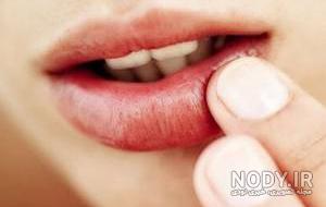 کبودی لب نوزاد تازه متولد شده کبودی لب نوزاد تازه متولد شده
