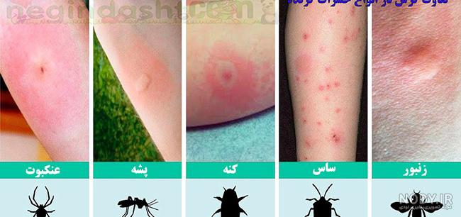 عکس بچه ساس