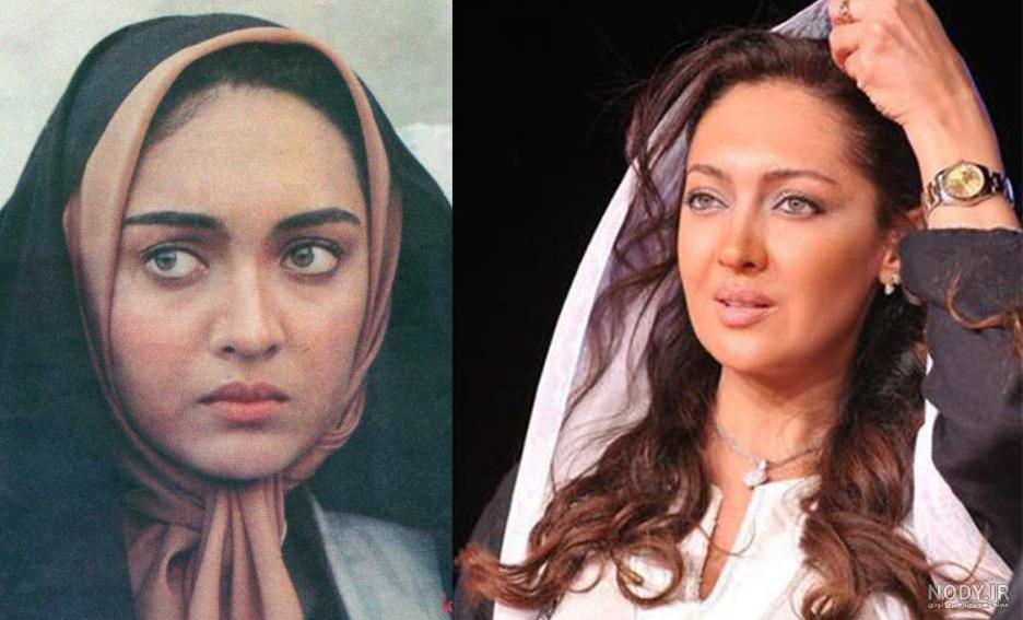 عکس قبل و بعد پروتز لب