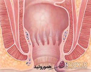 تصویر شقاق و بواسیر تصویر شقاق و بواسیر