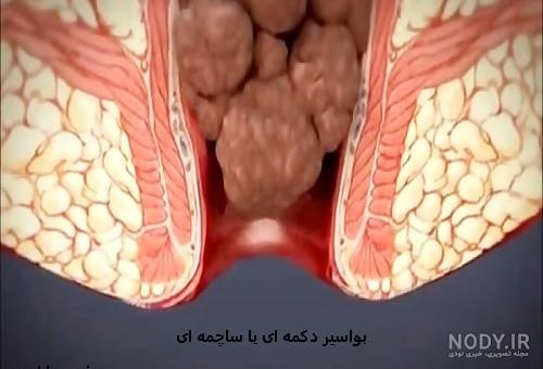 تصویر عمل بواسیر تصویر عمل بواسیر