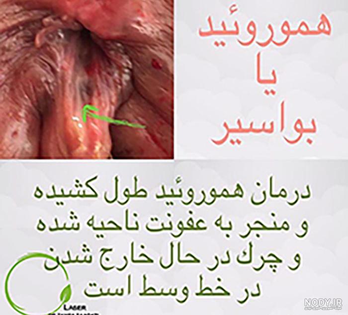 درمان بواسیر در زنان درمان بواسیر در زنان