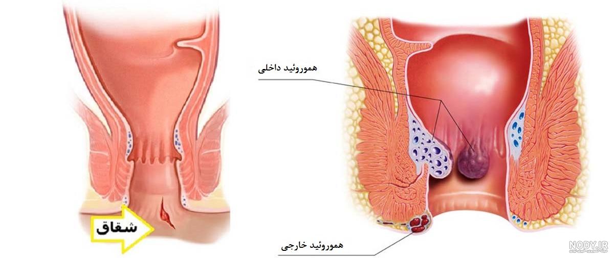 عکس بواسیر در بارداری عکس بواسیر در بارداری