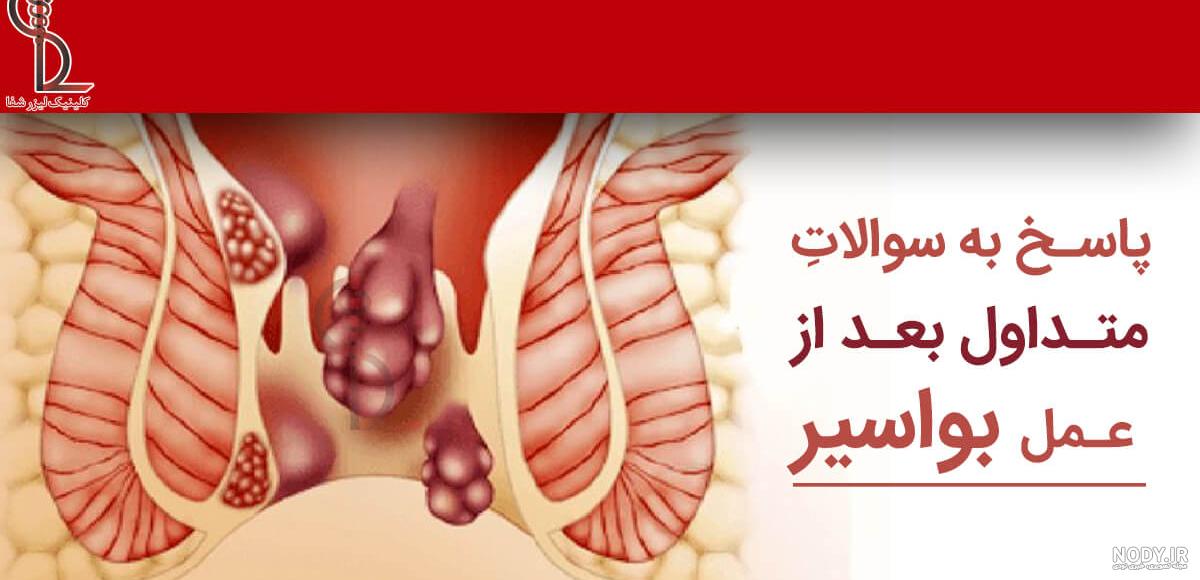 عکس بواسیر دکمه ای عکس بواسیر دکمه ای