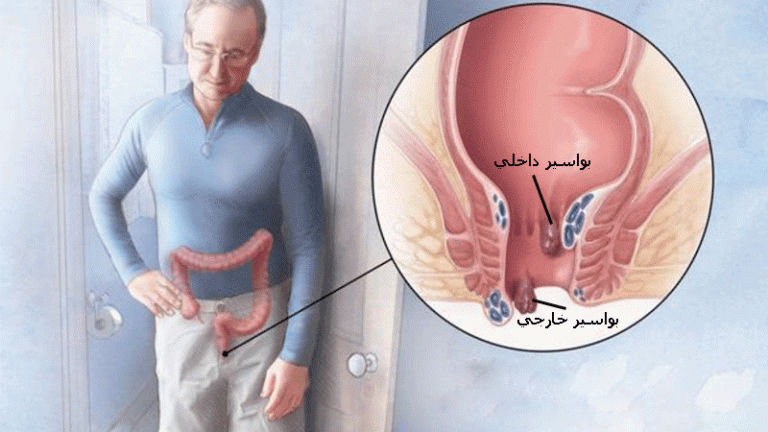 عکس بیماری باباسیل عکس بیماری باباسیل
