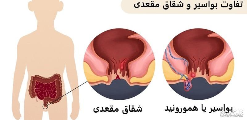 عکس هموروئید خفیف عکس هموروئید خفیف