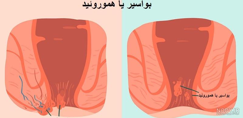 فیلم عمل بواسیر زنان فیلم عمل بواسیر زنان
