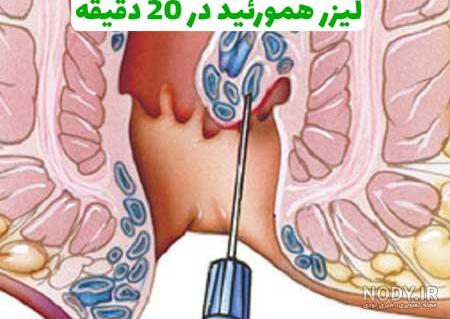 وازلین برای درمان بواسیر وازلین برای درمان بواسیر