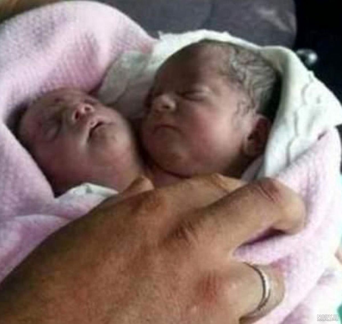 عکس بچه مرده در شکم مادر