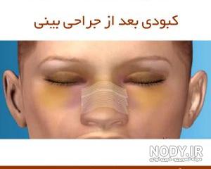 اب کرفس برای کبودی بعد عمل بینی اب کرفس برای کبودی بعد عمل بینی