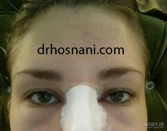 از بین بردن سریع کبودی بعد عمل از بین بردن سریع کبودی بعد عمل