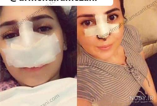 رفع قرمزی چشم بعد از عمل بینی رفع قرمزی چشم بعد از عمل بینی
