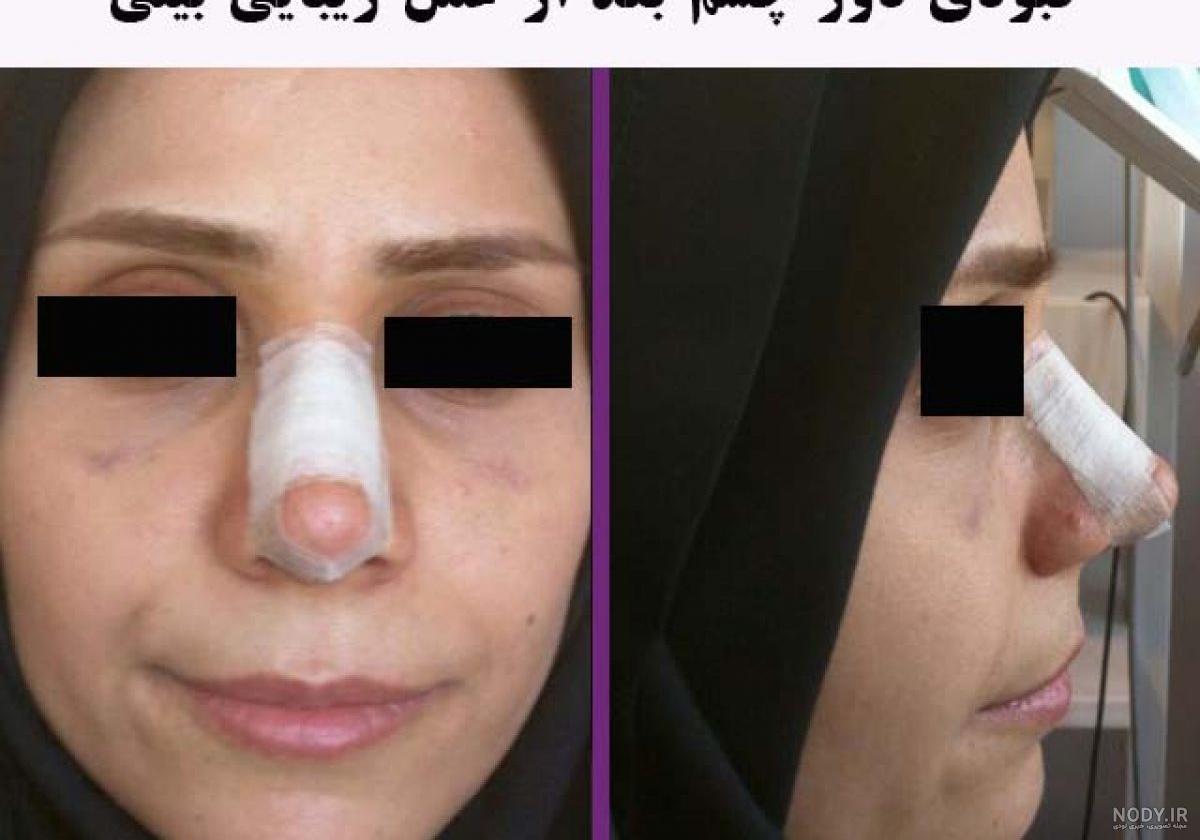عکس کبودی صورت بعد از عمل بینی عکس کبودی صورت بعد از عمل بینی