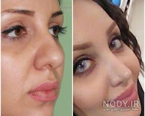 کمپرس گرم بعد از عمل بینی کمپرس گرم بعد از عمل بینی