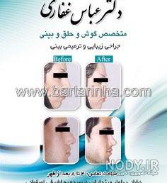 نمونه کار دکتر بهنام غفاری جراح بینی در ساری نمونه کار دکتر بهنام غفاری جراح بینی در ساری