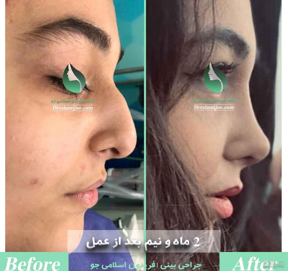 نمونه کار دکتر بهنام غفاری جراح بینی در ساری نمونه کار دکتر بهنام غفاری جراح بینی در ساری