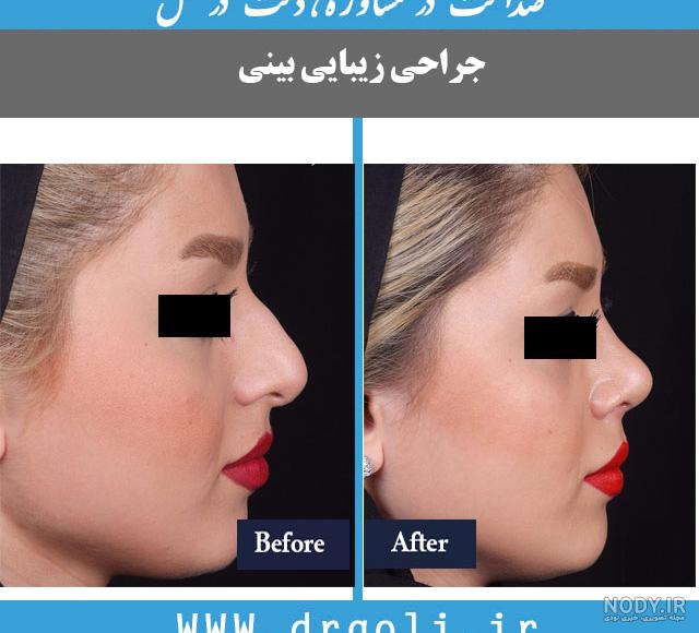 نمونه کار دکتر غفاری جراح بینی در ساری نمونه کار دکتر غفاری جراح بینی در ساری