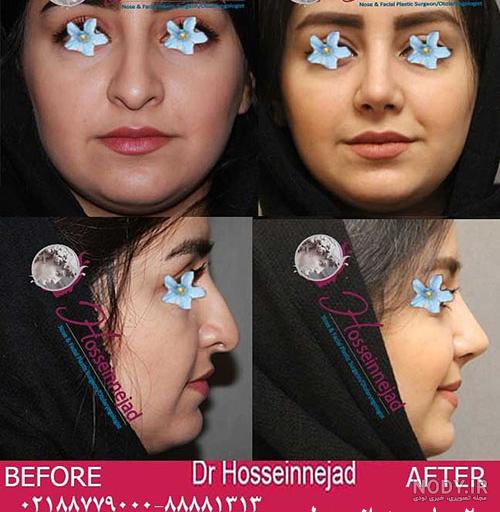 هزینه عمل بینی دکتر علی اصغر غفاری هزینه عمل بینی دکتر علی اصغر غفاری