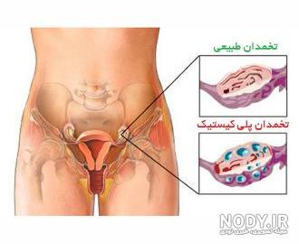 داروی گیاهی جهت تخلیه کامل رحم داروی گیاهی جهت تخلیه کامل رحم