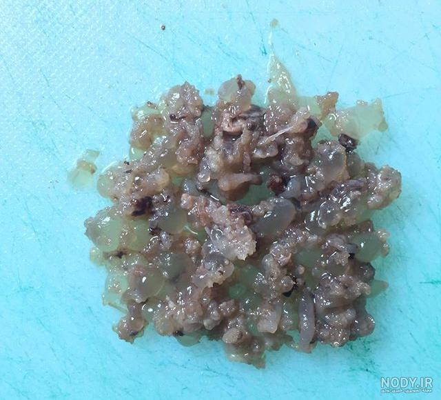 سرطان بچه خوره نی نی سایت سرطان بچه خوره نی نی سایت