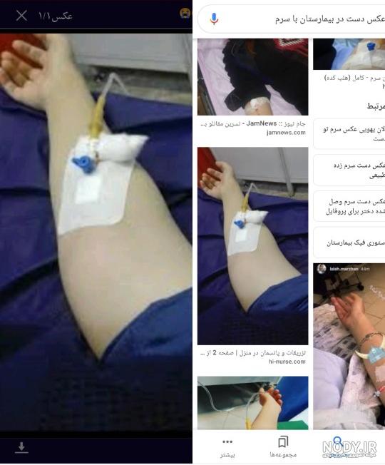 عکس دست سرم زده طبیعی