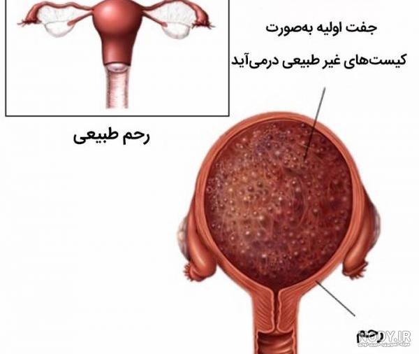 مول بدخیم مول بدخیم
