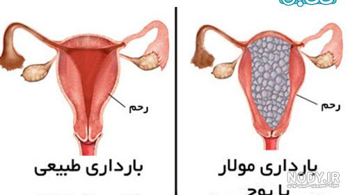 کیا بعد از حاملگی مولار بارداری سالمی داشتن کیا بعد از حاملگی مولار بارداری سالمی داشتن