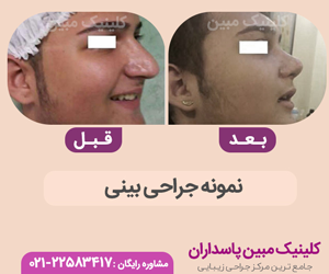 ویزر لیپو در شیراز ویزر لیپو در شیراز