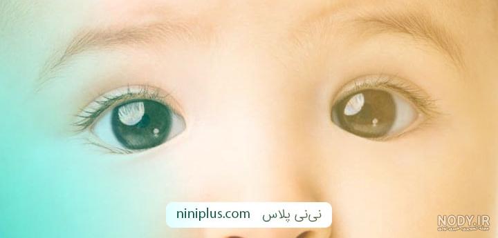 درصد موفقیت عمل انحراف چشم