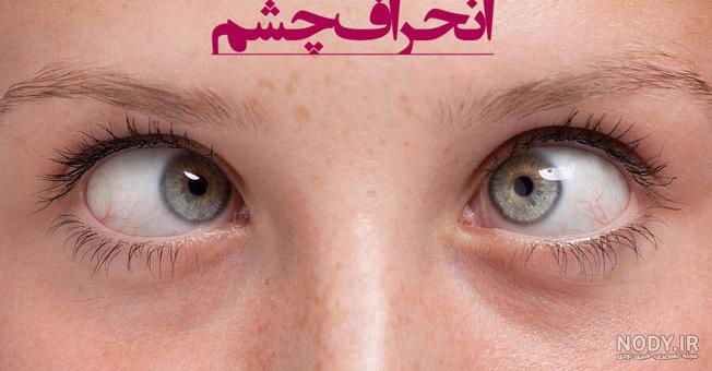 ورزش برای تنبلی چشم