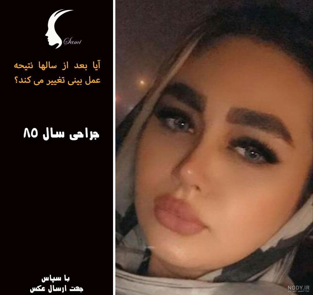 از بین بردن سریع کبودی بعد عمل