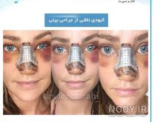 برای ورم بعد از عمل بینی چه بخوریم
