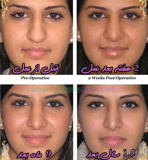 بعد از عمل بینی چی بخوریم نی نی سایت