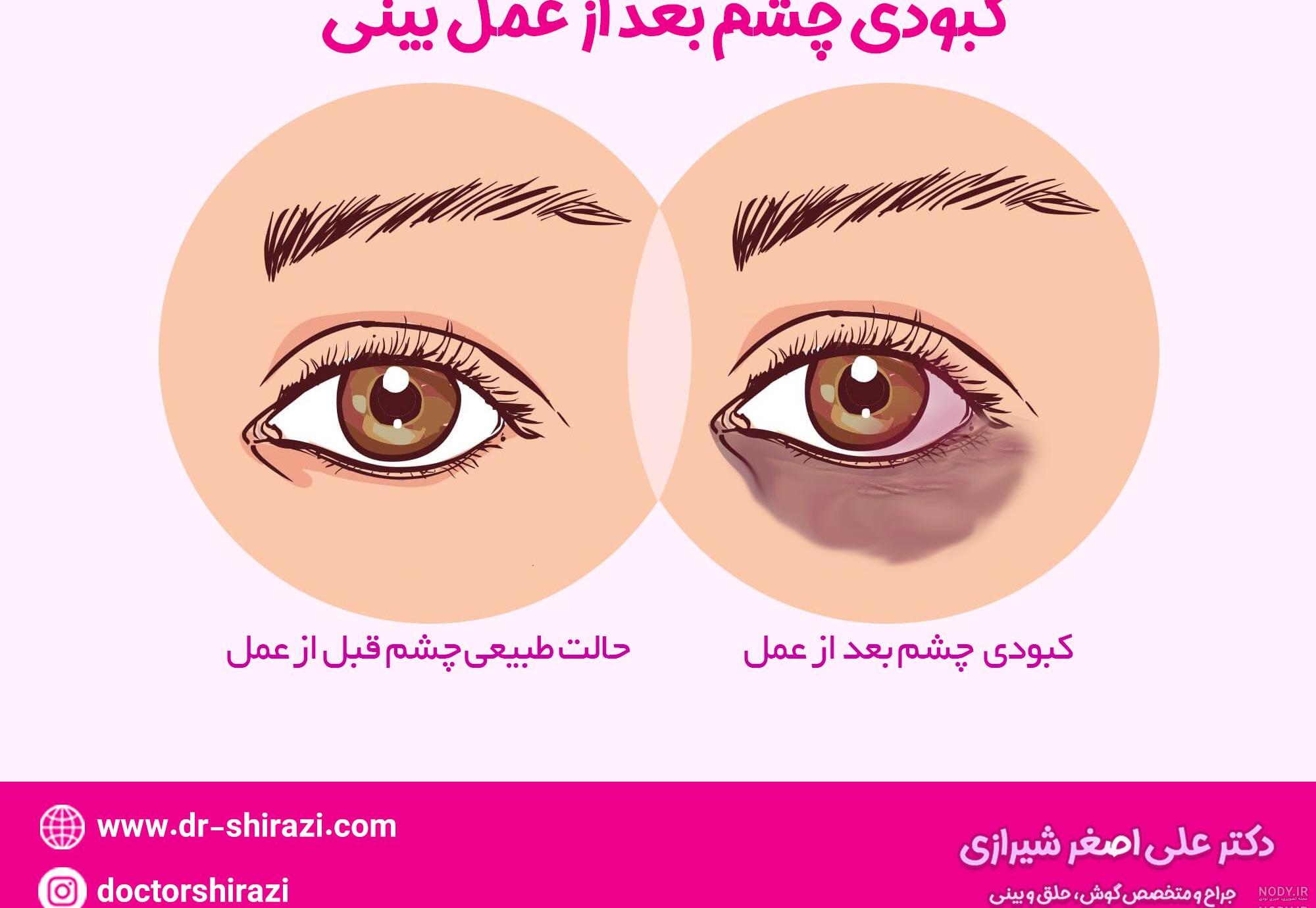رفع کبودی زیر چشم بعد از عمل بینی نی نی سایت