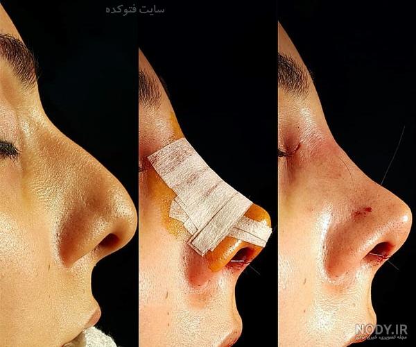 رفع کبودی زیر چشم بعد از عمل پلک
