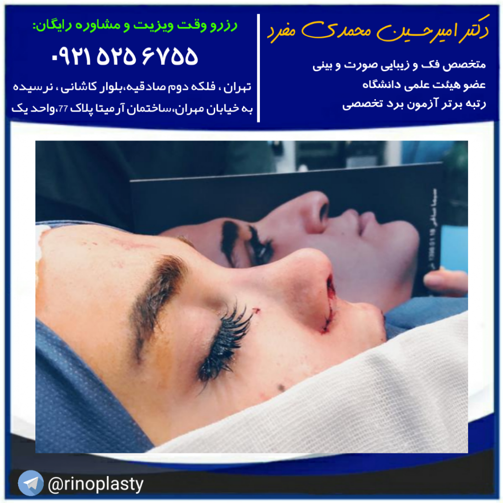 عکس قبل و بعد عمل افتادگی پلک