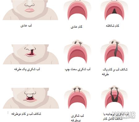 درمان لب شکری در طب سنتی