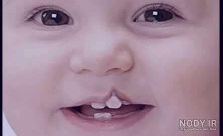 علت لب شکری در طب اسلامی