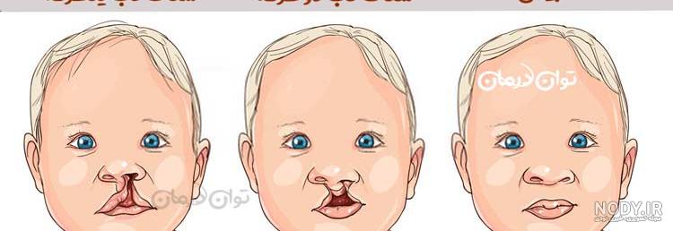 عمل رایگان لب شکری