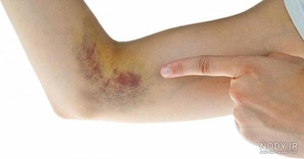 عکس آنژیوکت روی دست عکس آنژیوکت روی دست